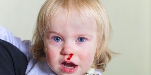 Beitragsbild des Blogbeitrags Mein Kind hat ständig Nasenbluten – Die besten Hausmittel für Kinder 