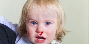 Beitragsbild des Blogbeitrags Mein Kind hat ständig Nasenbluten – Die besten Hausmittel für Kinder
