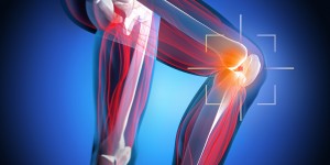 Beitragsbild des Blogbeitrags Arthrofibrose am Knie behandeln und heilen 