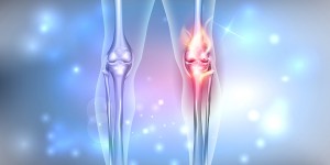 Beitragsbild des Blogbeitrags Was ist Arthrofibrose? Was tun bei Arthrofibrose? 