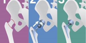Beitragsbild des Blogbeitrags Wechsel von Knie- und Hüftprothesen: Fallzahlen wichtig