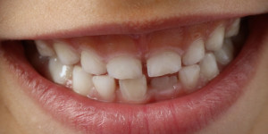 Beitragsbild des Blogbeitrags MIH: Die neue Zahnkrankheit lässt Kinderzähne bröckeln 