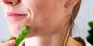 Beitragsbild des Blogbeitrags Hilft Aloe Vera gegen Pickel?