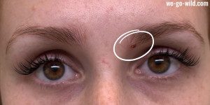 Beitragsbild des Blogbeitrags Muttermal entfernen im Gesicht: Meine Erfahrung! 