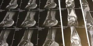 Beitragsbild des Blogbeitrags Stoßwellentherapie – Letzte Hilfe bei Tibialis Posterior Entzündung?