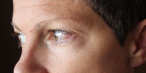 Beitragsbild des Blogbeitrags Rotes Auge – oder: Wenn’s gar windig ist…