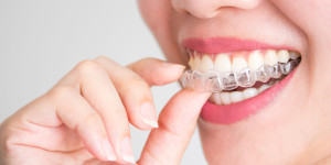 Beitragsbild des Blogbeitrags Unsichtbare Zahnspange aus Türkei – Invisalign 