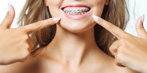 Beitragsbild des Blogbeitrags Brackets: wie festsitzende Zahnspangen Zähne zurechtrücken 