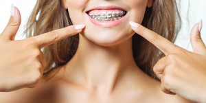 Beitragsbild des Blogbeitrags Brackets: wie festsitzende Zahnspangen Zähne zurechtrücken