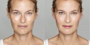 Beitragsbild des Blogbeitrags Pigmentflecken im Gesicht: Nein danke! 