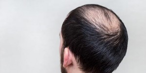 Beitragsbild des Blogbeitrags Kreisrunder Haarausfall: Ursache und Therapieformen 