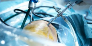 Beitragsbild des Blogbeitrags Meniskus-OP: von Narkose bis Nachbehandlung