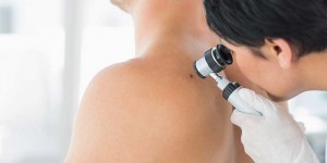 Beitragsbild des Blogbeitrags Schwarzer Hautkrebs: warum ist ein malignes Melanom gefährlich?