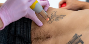 Beitragsbild des Blogbeitrags Dr. Petra Hirtler – die Spezialistin für Tattooentfernung