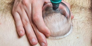 Beitragsbild des Blogbeitrags Schröpfen und wo es hilft