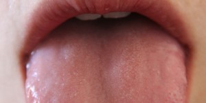 Beitragsbild des Blogbeitrags Pilzinfektion im Mund – was sie tun können! 