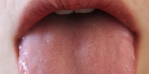 Beitragsbild des Blogbeitrags Pilzinfektion im Mund – was sie tun können!