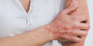 Beitragsbild des Blogbeitrags Psoriasis (Schuppenflechte) – Ursachen und Heilung