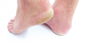 Beitragsbild des Blogbeitrags Die besten Hausmittel gegen Fußpilz 