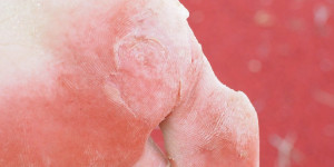 Beitragsbild des Blogbeitrags Welche Hausmittel helfen gegen Hautpilz? 