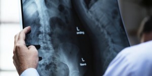 Beitragsbild des Blogbeitrags Osteoporose – weltweit deswegen alle drei Sekunden eine Fraktur