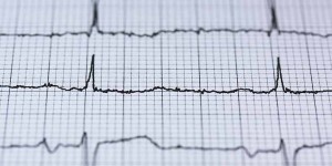 Beitragsbild des Blogbeitrags Vorhofflimmern: Unterversorgung in Ö gefährdet Herzgesundheit 