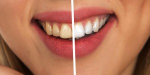 Beitragsbild des Blogbeitrags Wichtig: verschieben sie wegen Corona NICHT den Zahnarztbesuch! 