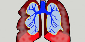 Beitragsbild des Blogbeitrags COPD: Wenn die Luft wegbleibt – trotz Pandemie Therapie fortführen