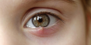 Beitragsbild des Blogbeitrags Gerstenkorn: so wird man die lästige Entzündung am Auge wieder los