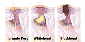 Beitragsbild des Blogbeitrags Was ist der Unterschied zwischen Blackheads & Whiteheads? 