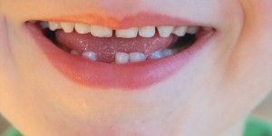 Beitragsbild des Blogbeitrags Die Wackelzahn-Pubertät