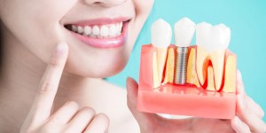 Beitragsbild des Blogbeitrags Zahnimplantat: Voraussetzung, Behandlung, Vor- und Nachteile 