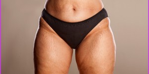 Beitragsbild des Blogbeitrags Dehnungsstreifen entfernen? Das kannst Du tun + Tipps
