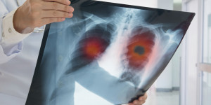 Beitragsbild des Blogbeitrags Gute Nachrichten zum Weltkrebstag: Bahnbrechende Therapiefortschritte bei Lungenkrebs 