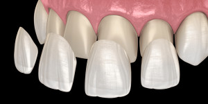 Beitragsbild des Blogbeitrags Veneers – Alles rund um das weiße Lächeln