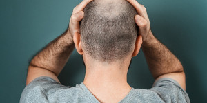 Beitragsbild des Blogbeitrags Hormonell bedingter Haarausfall – wenn die Hormone zur Kahlköpfigkeit führen