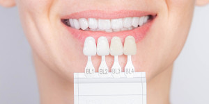 Beitragsbild des Blogbeitrags Veneers für Zähne – die Vorteile und Nachteile