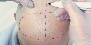 Beitragsbild des Blogbeitrags Haarausfall – wann ist eine Haartransplantation sinnvoll?
