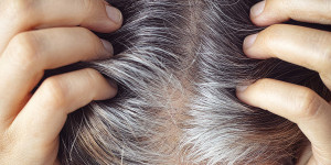 Beitragsbild des Blogbeitrags Schmerzhaft und unschön zu gleich – so ist Haarausfall durch eine Haarwurzelentzündung