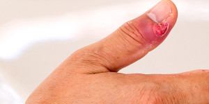 Beitragsbild des Blogbeitrags Nagelbettentzündung Hausmittel: für gesunde Zehen und Finger 
