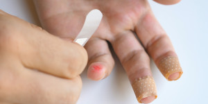 Beitragsbild des Blogbeitrags Pflasterallergie im Griff: Ursachen, Pflege und Vorbeugung