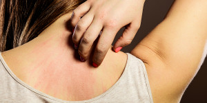 Beitragsbild des Blogbeitrags Schweißallergie: Ursachen, Symptome und Behandlung 