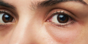 Beitragsbild des Blogbeitrags Tränensäcke, geschwollene Augen und Malar Bags - woher sie kommen und was tun kannst