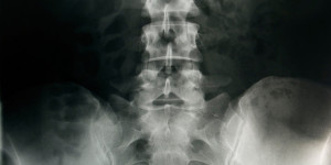 Beitragsbild des Blogbeitrags Low Bone Density And Hypothalamic Amenorrhea