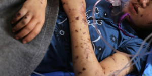 Beitragsbild des Blogbeitrags „Ich will meine Beine zurück“: Amputierte Kinder in Gaza 