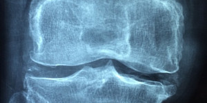 Beitragsbild des Blogbeitrags Methylsulfonylmethan (MSM) für Gelenkschmerzen
