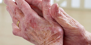 Beitragsbild des Blogbeitrags Die Studie zeigt einen Anstieg des Anteils der Erwachsenen in England, bei denen entzündliche Arthritis diagnostiziert wurde