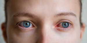 Beitragsbild des Blogbeitrags Was sind die Komplikationen, vorbeugenden Maßnahmen und Behandlungsmöglichkeiten bei Augenpocken? 