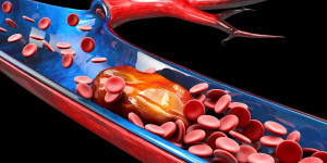 Beitragsbild des Blogbeitrags Untersuchung der Plasmasignaturen von aus Blutplättchen stammenden Proteinen bei akuter Lungenembolie 