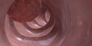Beitragsbild des Blogbeitrags Forscher identifizieren ein neues Gen, das für das Wachstum von Darmkrebs essentiell ist